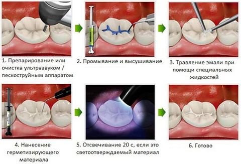 Герметизация фиссур 1 зуба детская стоматология no 1 томск