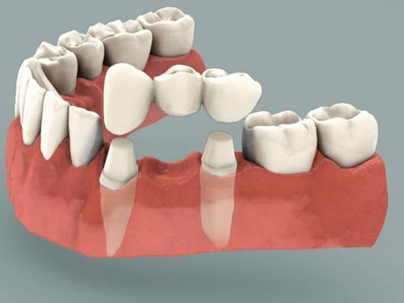 Мостовидные зубные протезы