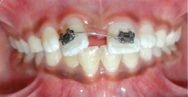 diastema2 diastema2