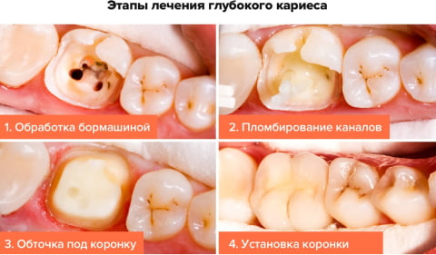 Что будет если долго не лечить кариес Чистка зубов Томск Катунская