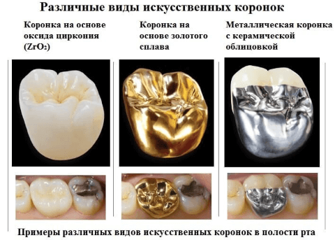 металлические коронки на зубы