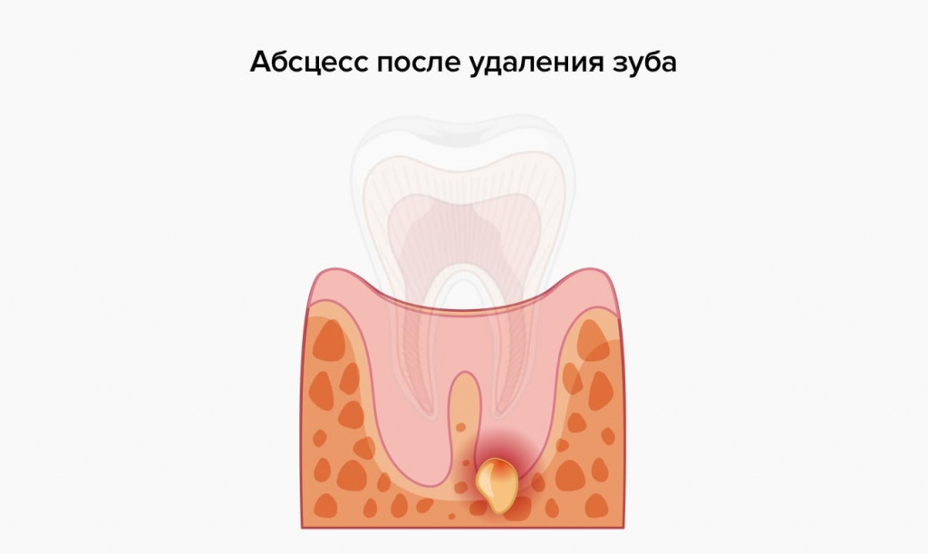 Проблемы после удаления зуба