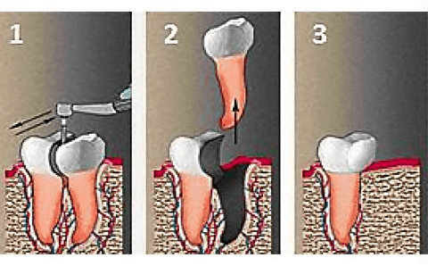 Этапы гемисекции зуба
