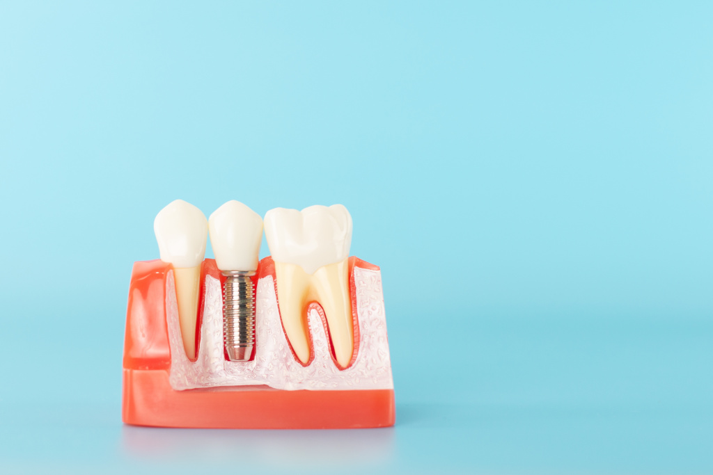 Чем зубные коронки на имплантах отличаются от обычных