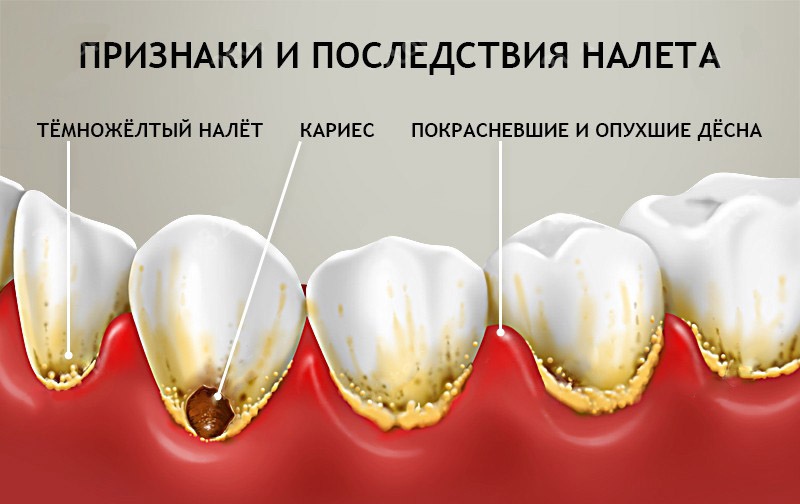 Зубной камень на зубах фото