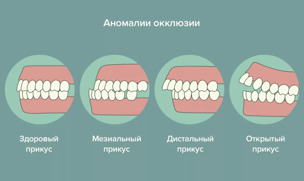 anomalii-polozheniya-zubov2