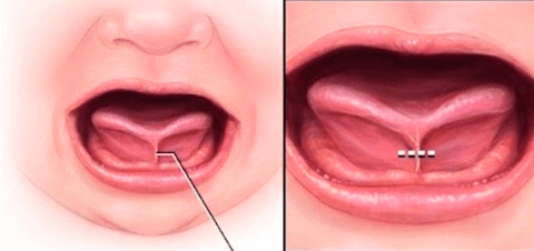 Подрезание уздечки языка у детей