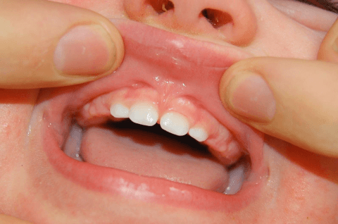 пластика уздечки губы