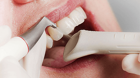 способы отбеливания зубов.png