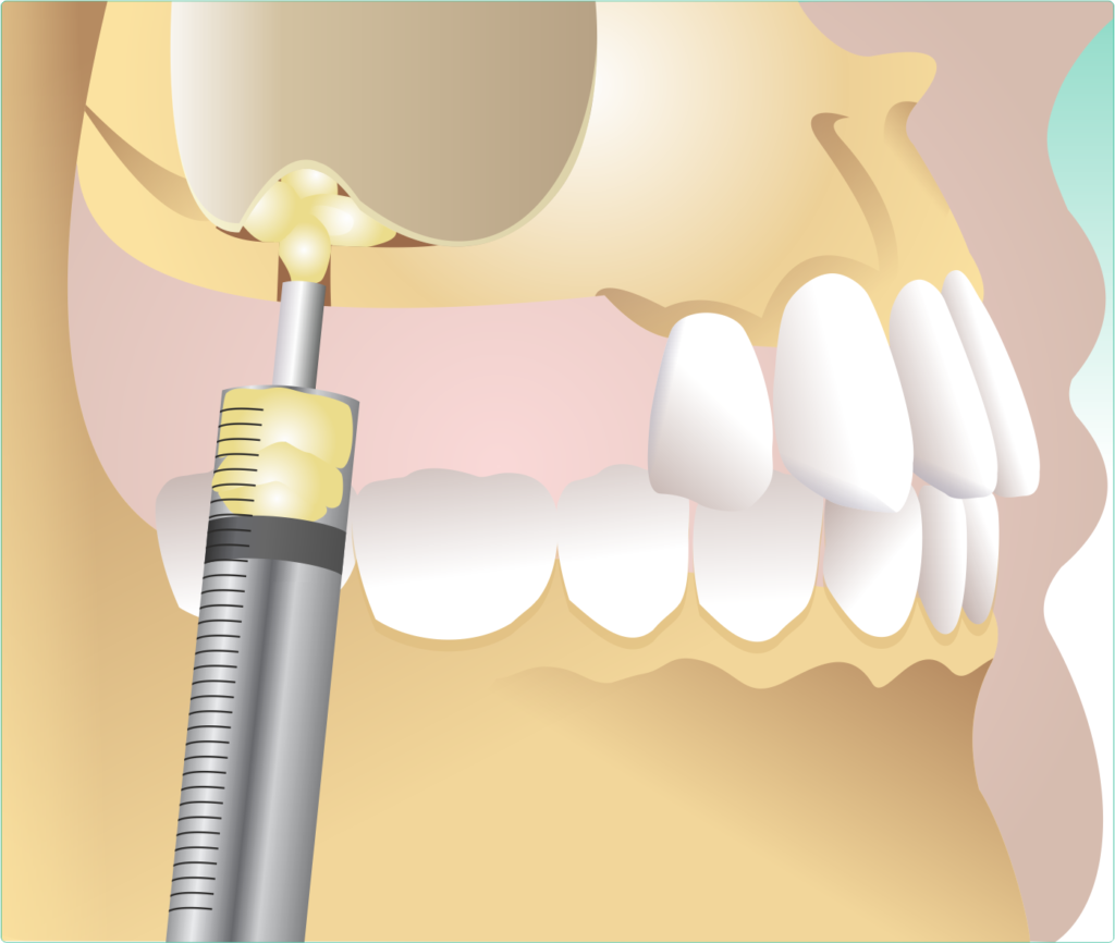 otkrytyy-sinus-lifting2.png