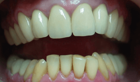металлопластмассовые коронки на зубы фото