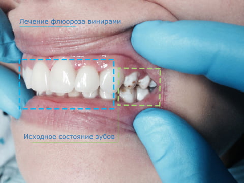 Реферат: Флюороз зубів