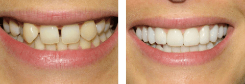 Что Такое Реставрация Зубов В Стоматологии Фото