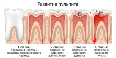 пульпит