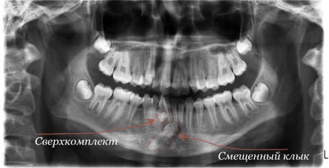 Что значит сверхкомплектный зуб