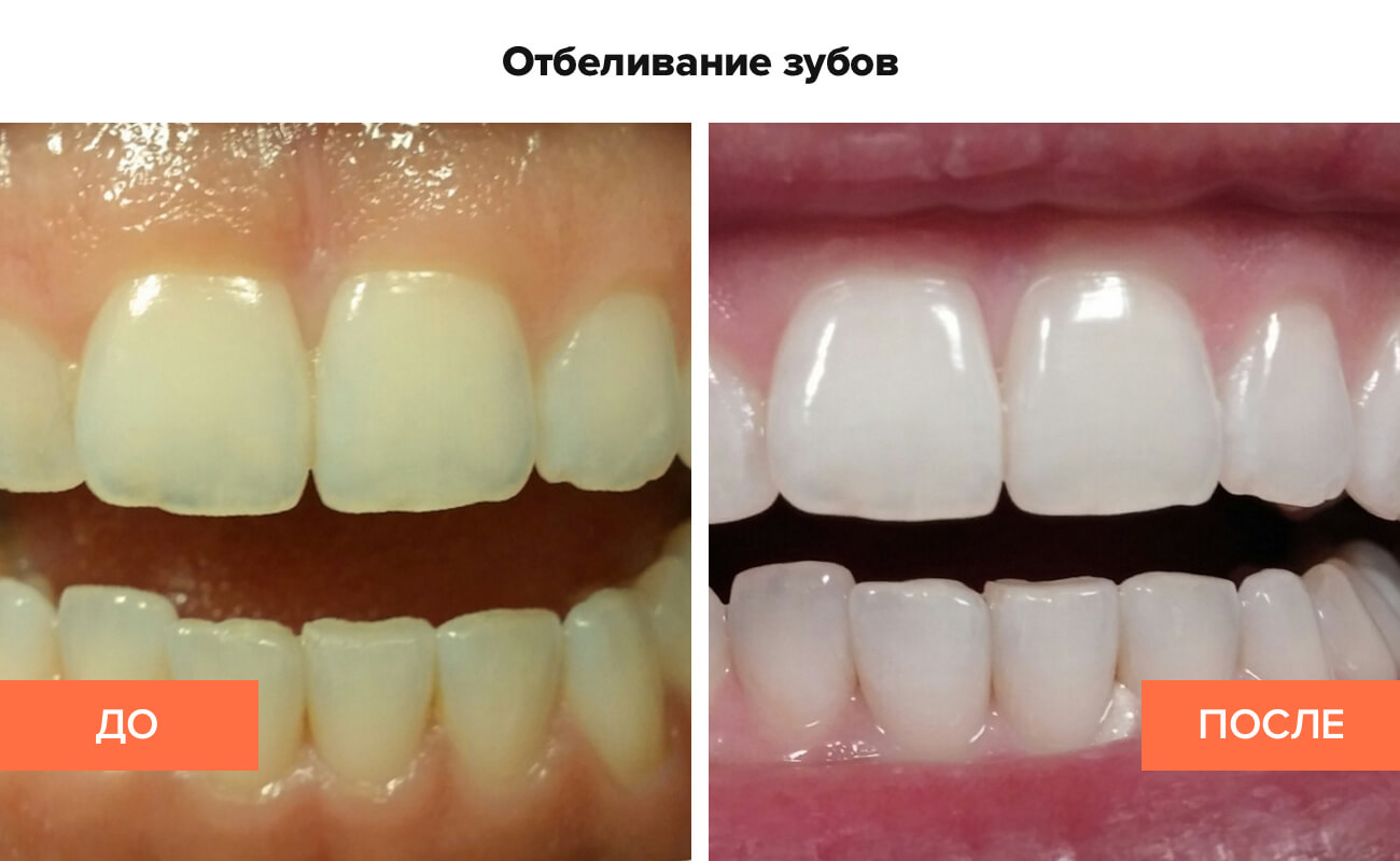 Лазерное отбеливание зубов до и после фото ирригатор купить смоленск